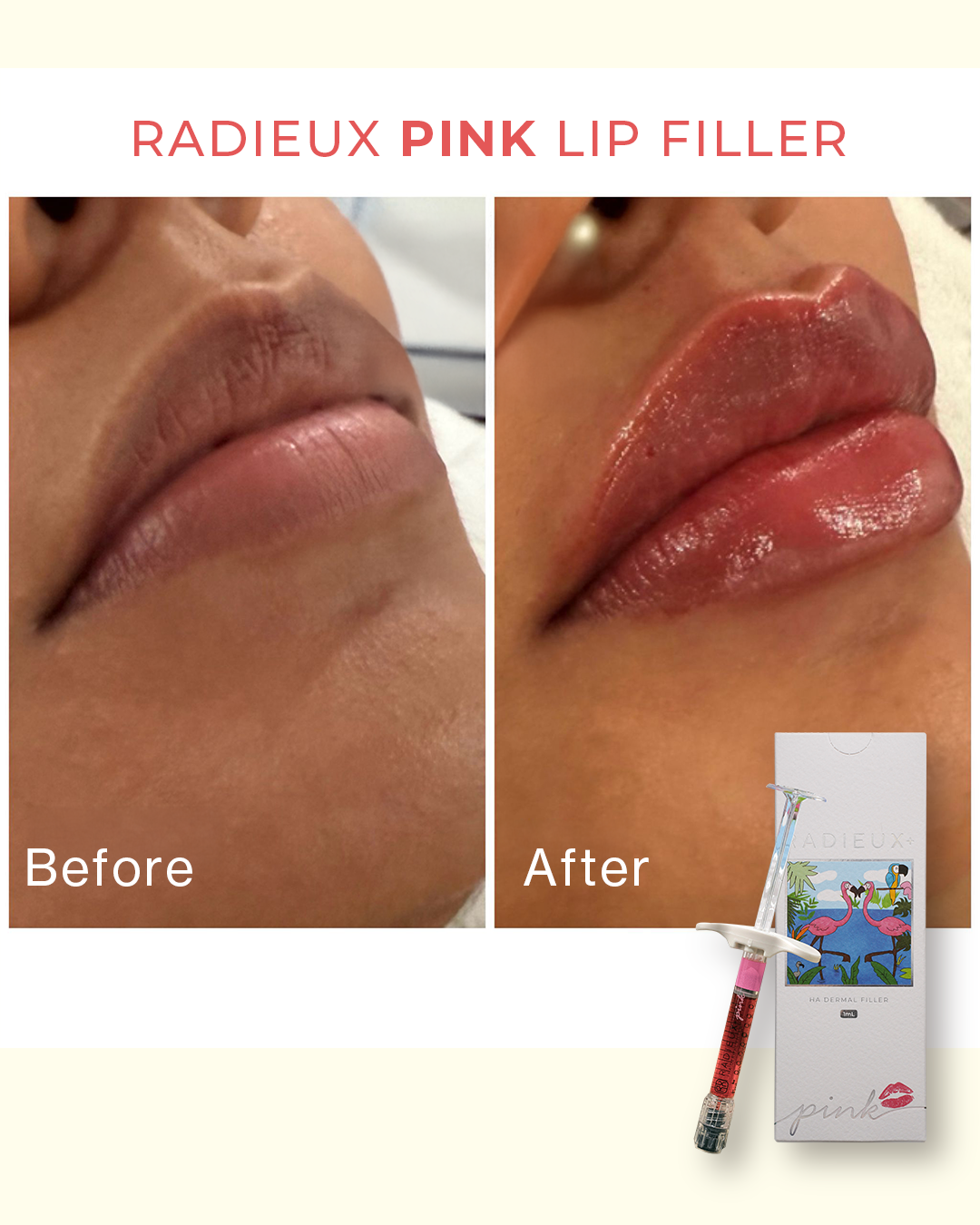 Radieux+ Pink Lip Filler 