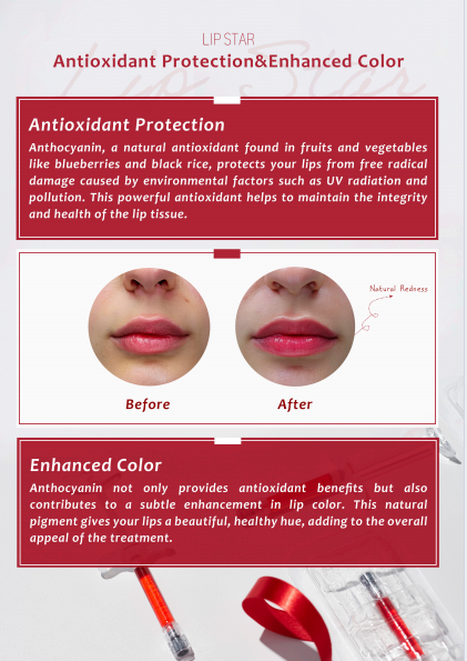 Lip Star Filler – SL Medical